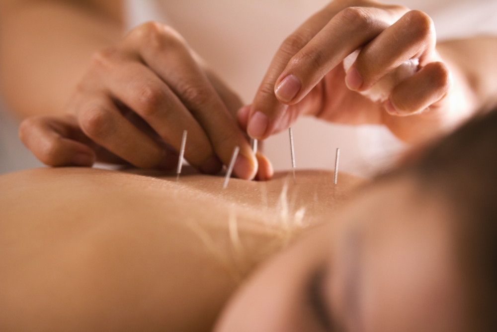 What is Acupuncture and What are its Benefits?